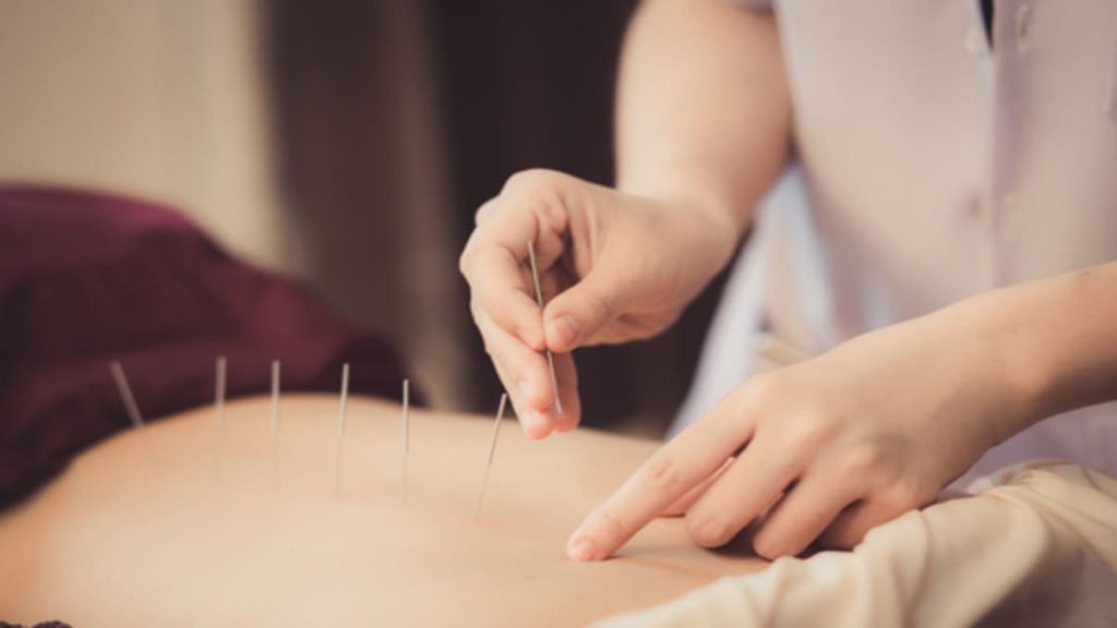 طب سوزنی برای کمک به کاهش درد دیسک کمر انجام طب سوزنی برای کاهش درد کمر