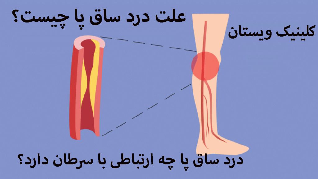 ساق پای انسان که قسمتی از آن با رنگ قرمز نشان داده شده است