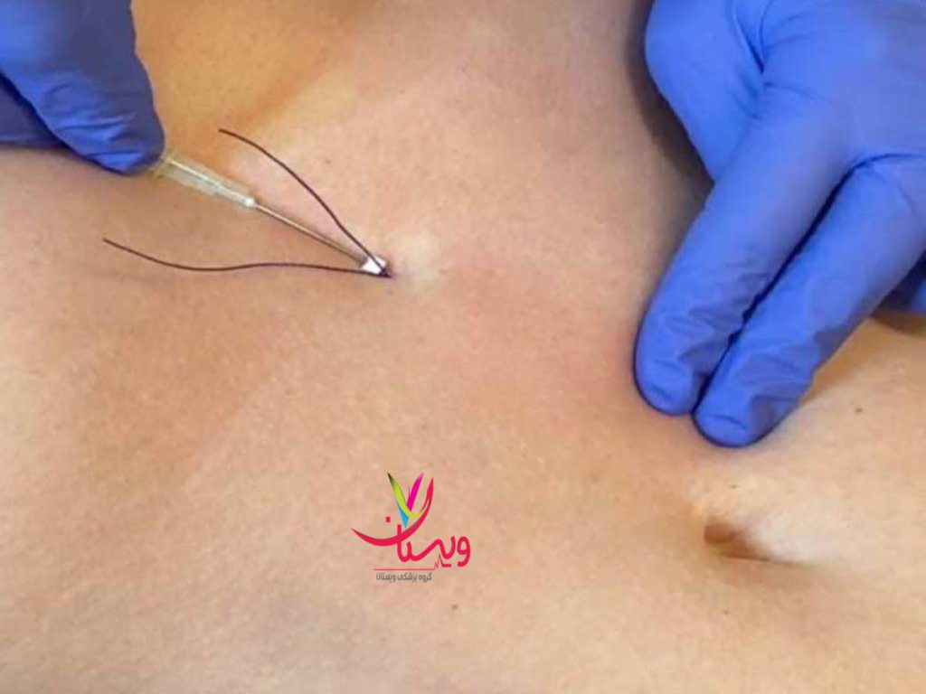 امبدینگ شکم نظرات در مورد امبدینگ لاغری