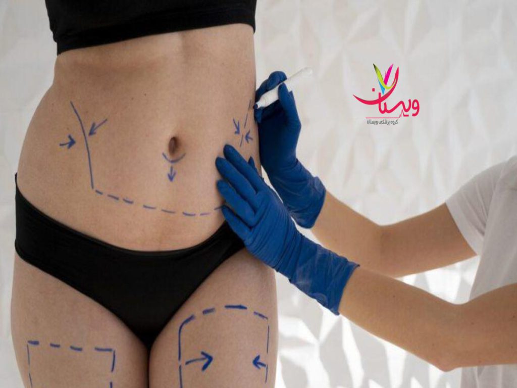 نظرات در مورد امبدینگ لاغری چیست