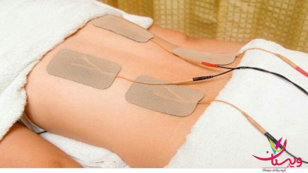 الکترودهای نوار عصب در پایین کمر پدهای الکترود روی کمر بیمار