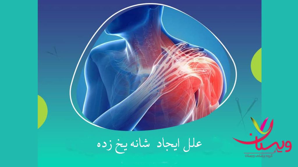علتهای بروز شانه یخ زده علل بوجود آمدن و درمان شانه یخ زده حکیم خیراندیش