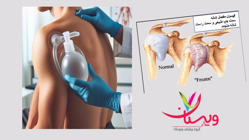 مداوای شانه یخ زده با بادکش استفاده از بادکش برای شانه یخ زده