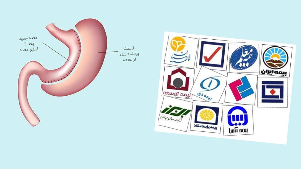 هزینه عمل اسلیو معده با بیمه سال 1404