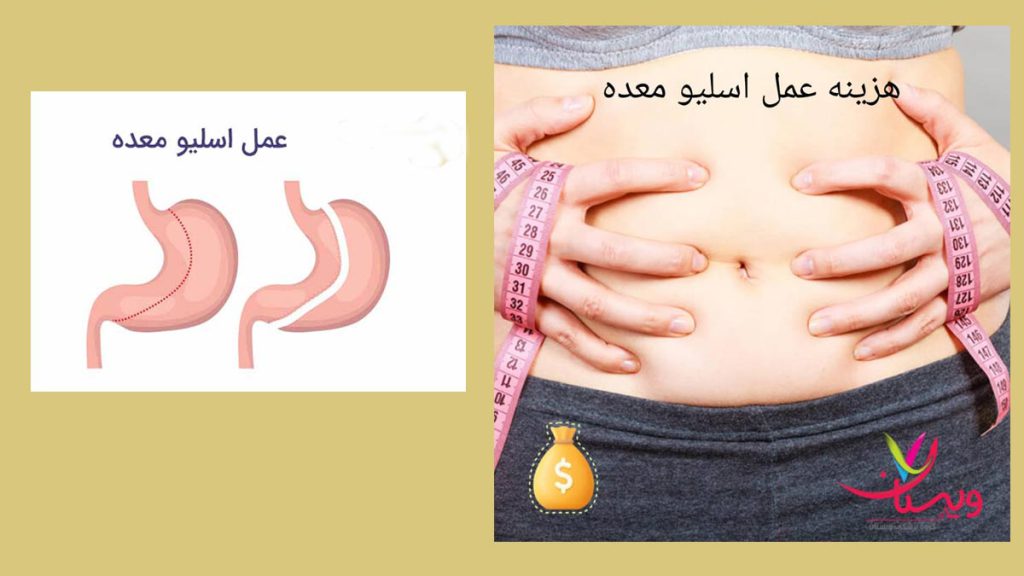 قیمت اسلیو معده در گروه پزشکی ویستان هزینه عمل اسلیو معده با بیمه گروه در ویستان