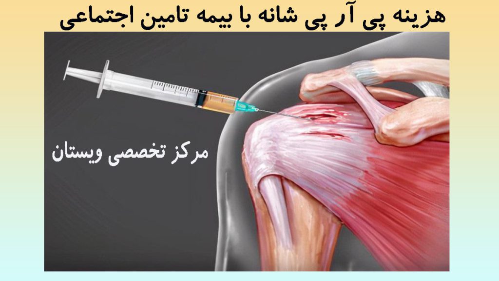 هزینه پی آر پی شانه شانه و مفصل و ماهیچه های آن-تزریق پی ار پی به شانه-نوشته :هزینه پی آر پی شانه با بیمه تامین اجتماعی