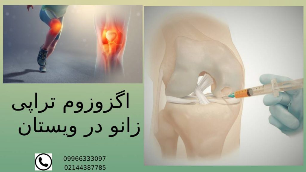 تعرفه اگزوزوم تراپی زانو در ویستان قیمت اگزوزوم تراپی زانو در گروه تخصص ویستان
