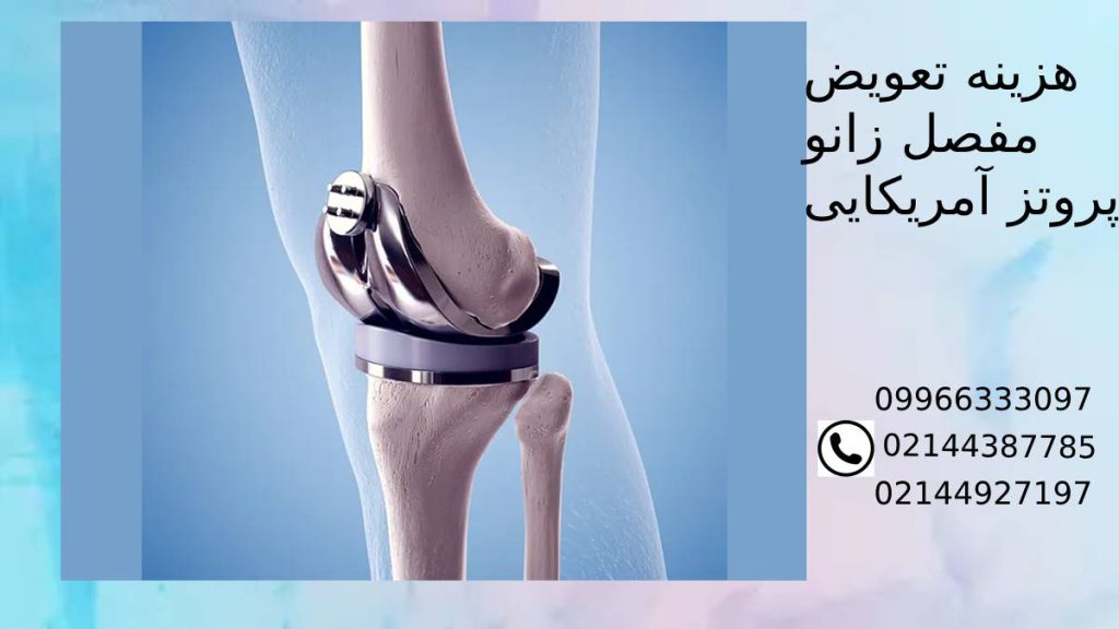 هزینه تعویض مفصل زانو با بیمه سال 1403