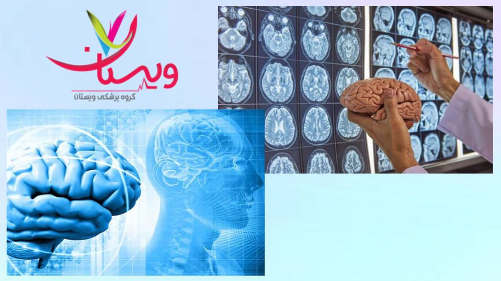 بهترین فوق تخصص سکته مغزی بهترین دکتر متخصص سکته مغزی در تهران