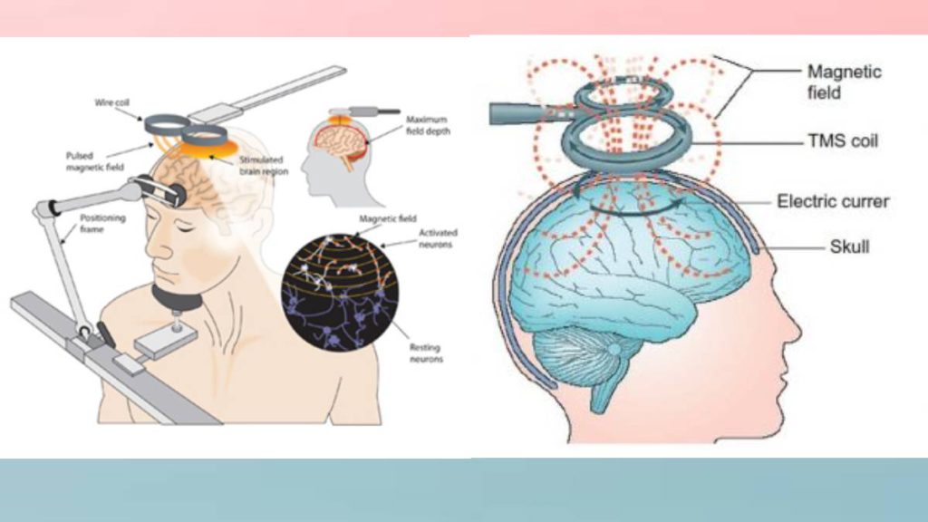 روش جدید درمان دوقطبی روشهای جدید اختلال دوقطبی