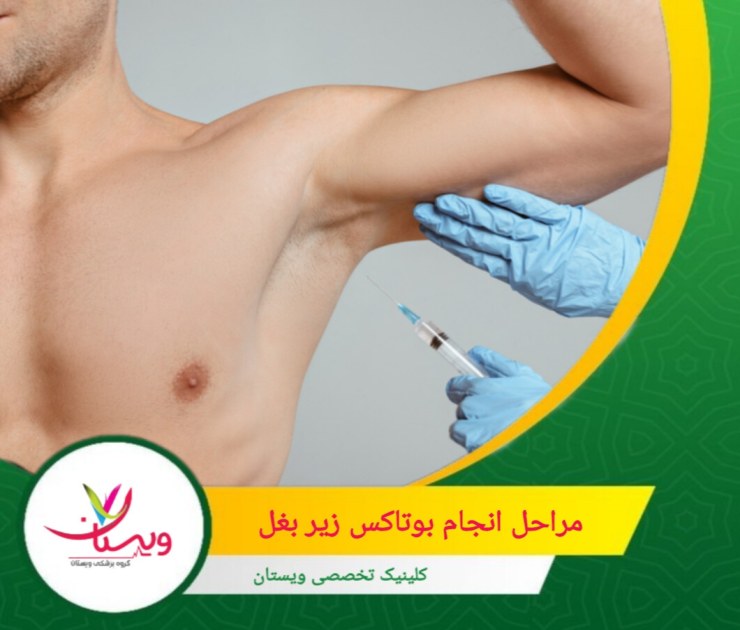 در ابتدا، پزشک با بررسی سابقه پزشکی و شرایط فردی شما، مناسب بودن این درمان را ارزیابی میکند. مراحل انجام بوتاکس زیر بغل