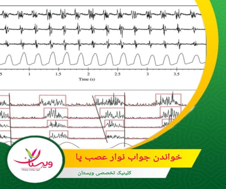 پاسخ های تاخیری، این شاخصها برای ارزیابی عملکرد بخشهای پروگزیمال عصب و ریشههای عصبی استفاده میشوند. خواندن جواب نوار عصب پا