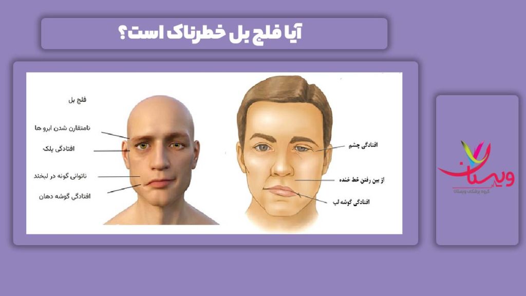 پر خطر بودن فلج بل خطرناک بودن فلج بل