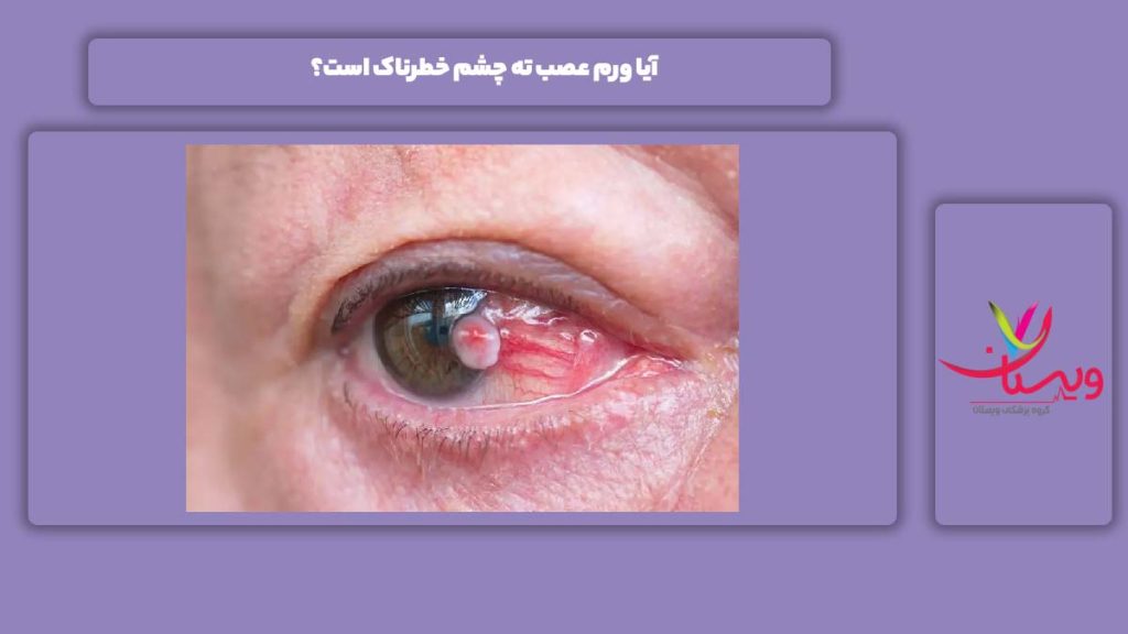 ورم عصب ته چشم و خطرناک بودن آن ورم عصب انتهای چشم