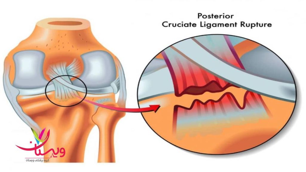 تفاوت پارگی و کشیدگی تفاوت پارگی و کشیدگی رباط زانو