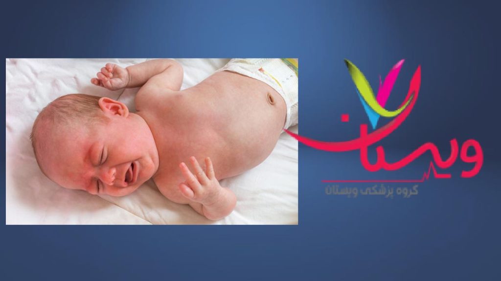 توبروز اسکلروزیس در نوزادها توبروز اسکلروزیس در نوزاد