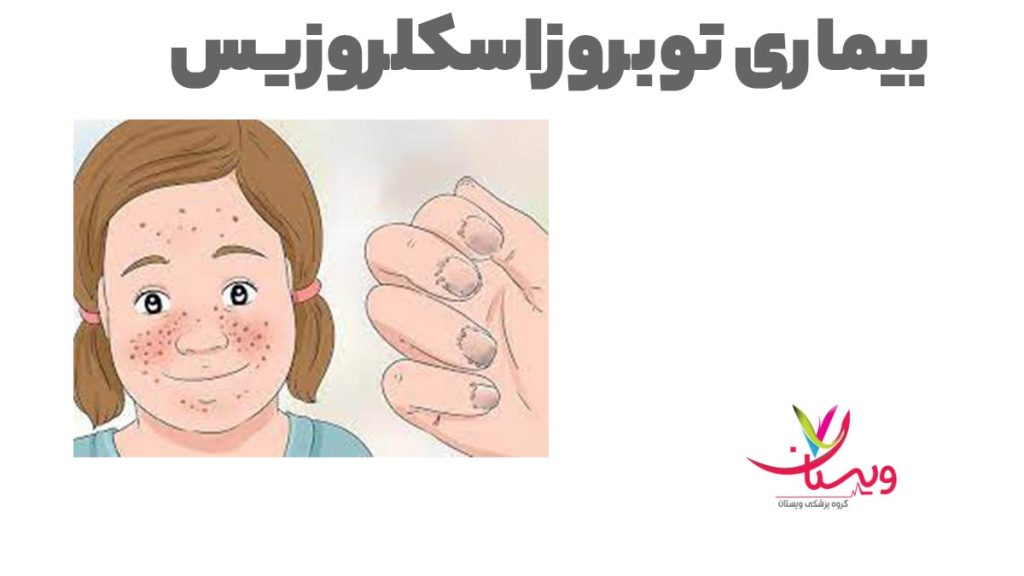 توبروز اسکلروزیس