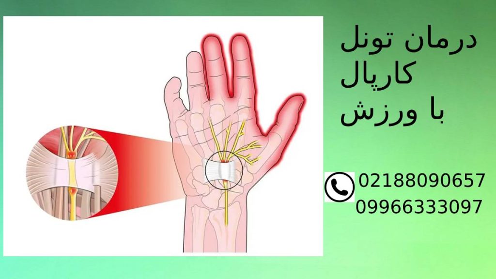 تونل کارپال با ورزش درمان سندروم تونل کارپال با حرکات ورزشی