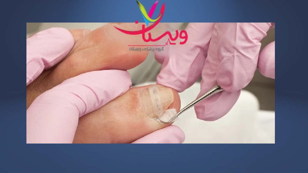 جراحی ضایعات ناخنی و پوستی درمان با جراحی ضایعات ناخنی و پوستی