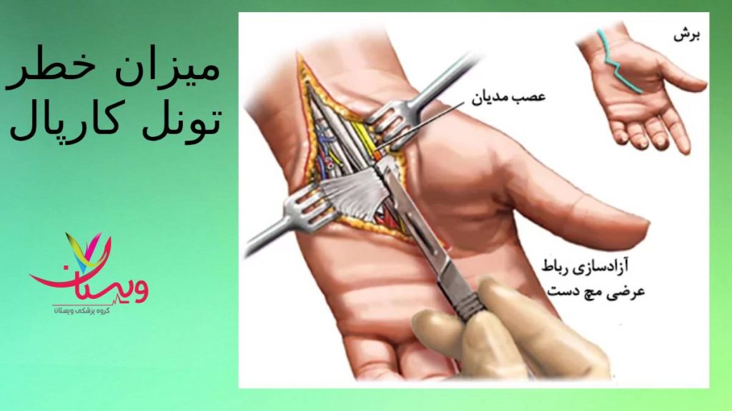 عوارض جدی سندروم تونل کارپال تونل کارپال چه خطراتی دارد؟