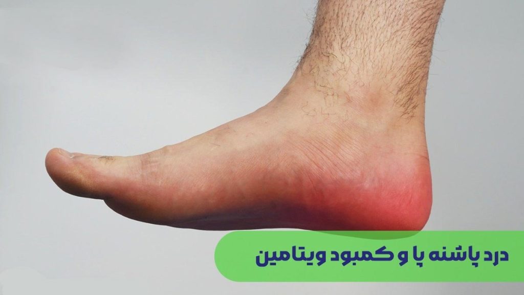 درد پاشنه با کمبود ویتامین