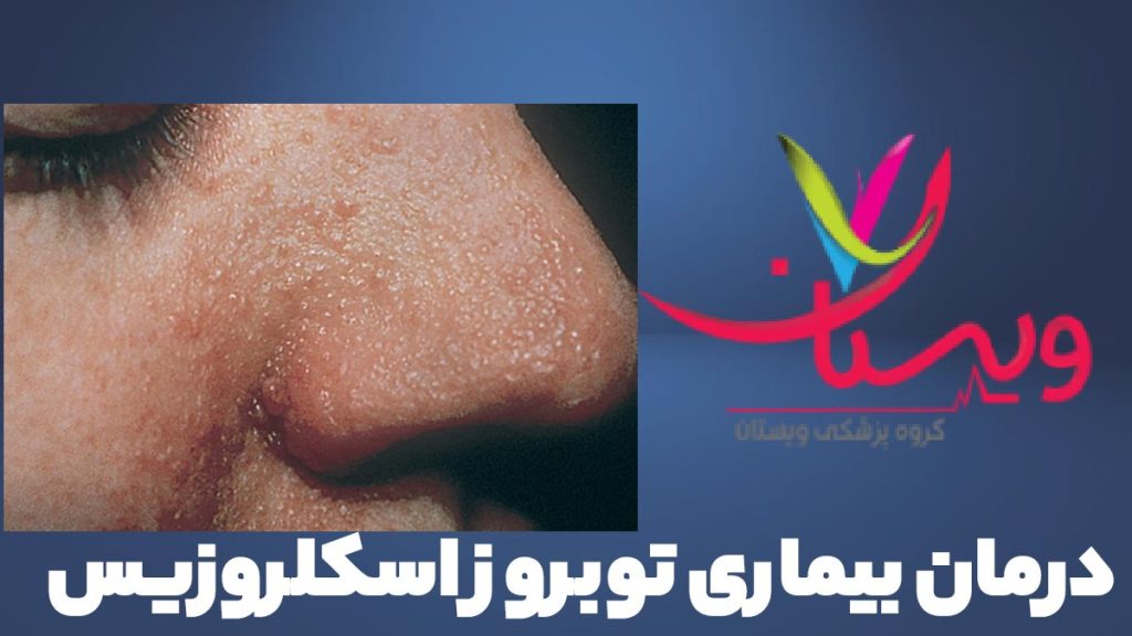 درمان توبروز اسکلروزیس درمان توبروز اسکلروزیس