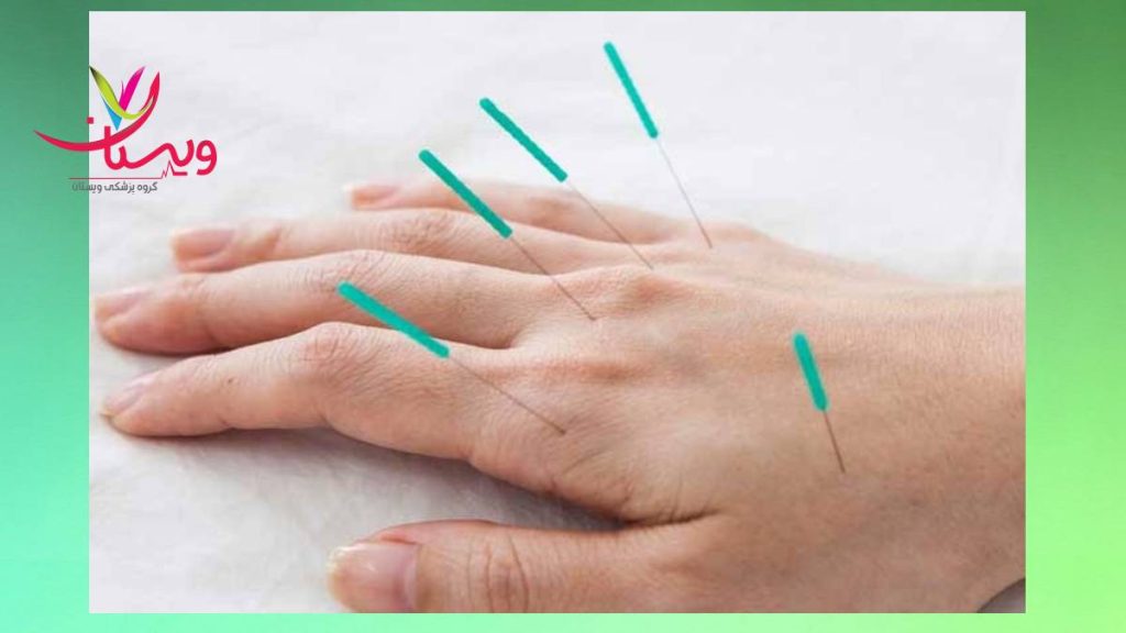 طب سوزنی و درمان سندروم تونل کارپال درمان سندروم تونل کارپال با شیوه طب سوزنی