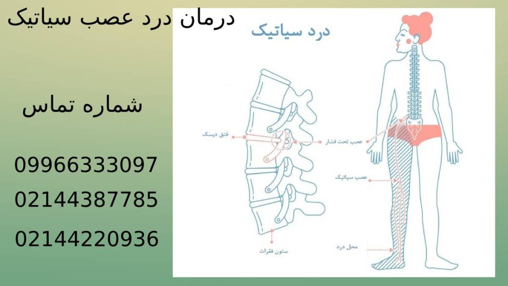 بهبودی و درمان درد عصب سیاتیک