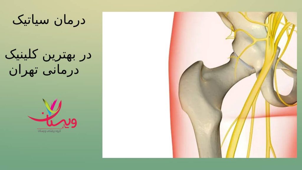 درمان سیاتیک با گروه ویستان درد عصب سیاتیک در مرکز تهران