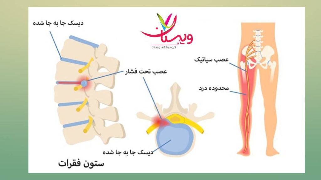 بهبود همیشگی عصب سیاتیک راهکار درمان دائمی درد سیاتیک