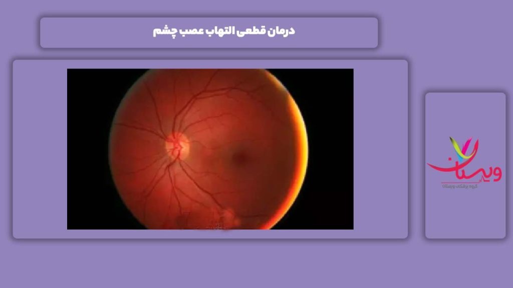 درمان قطعی نوریت بینایی نوریت بینایی