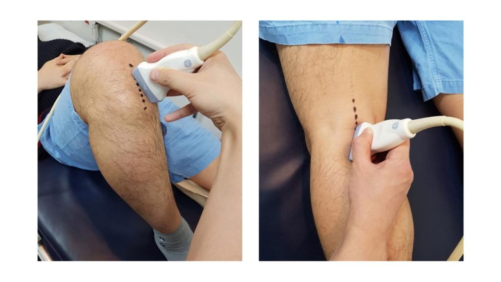 درمان پارگی رباط زانو درمان پارگی رباط زانو