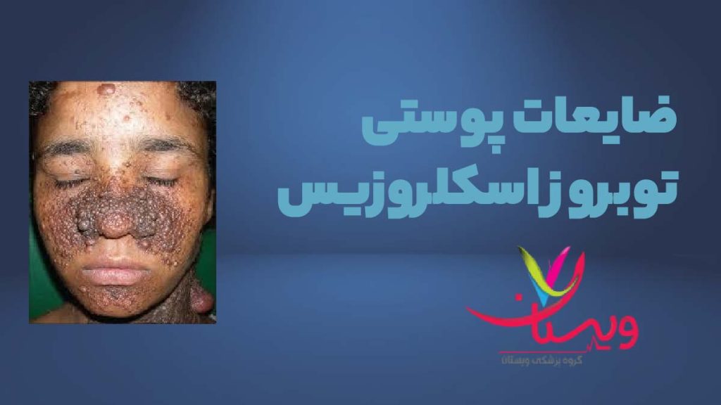 توبروز اسکلروزیس