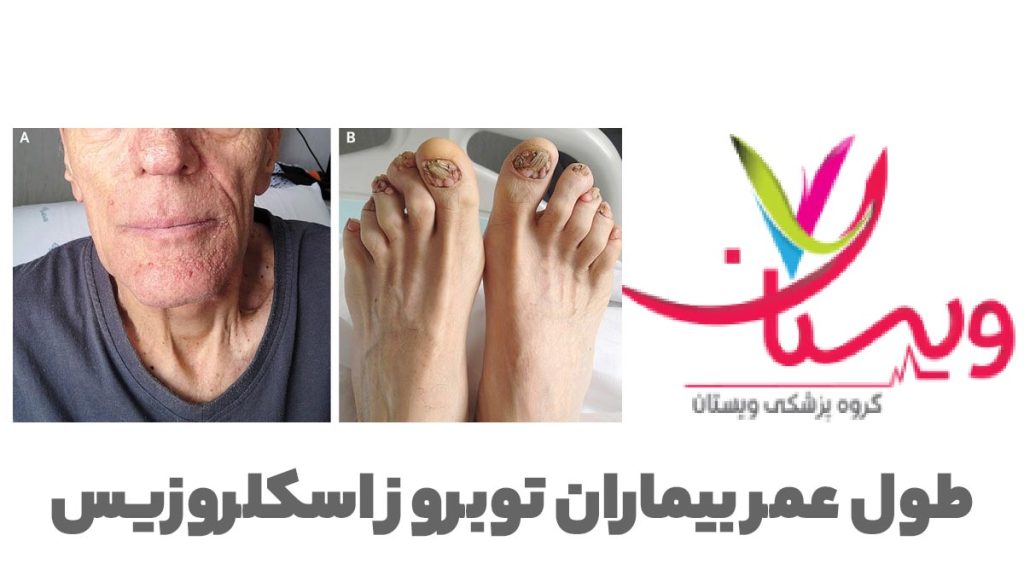 عمر بیماری توبروز اسکلروزیس طول عمر بیمار توبروز اسکلروزیس