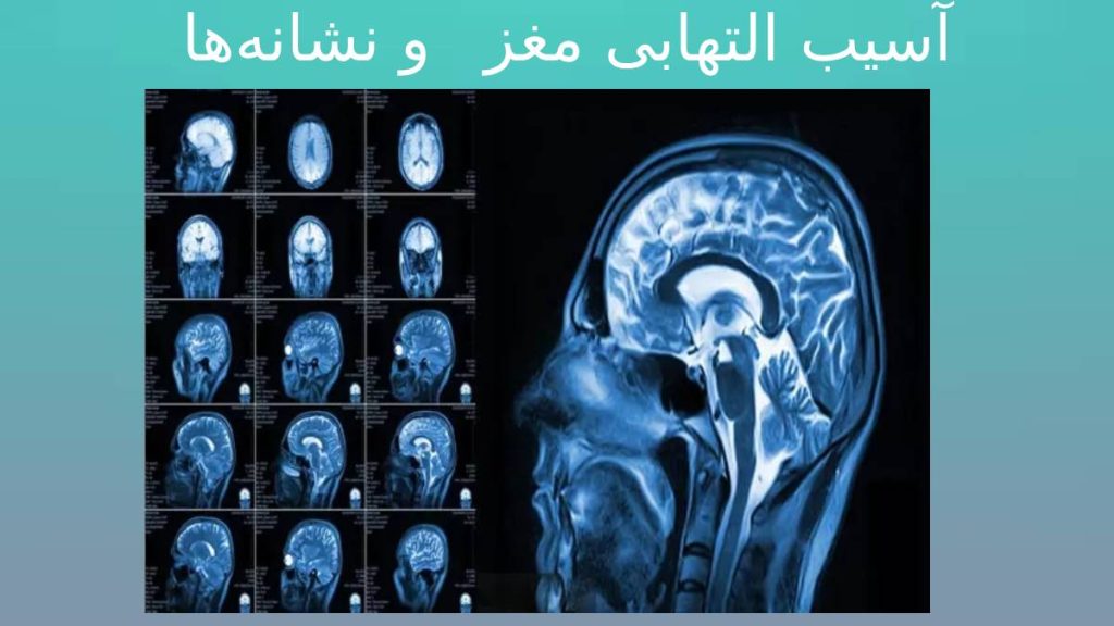 علائم التهابی بافت مغز نشانههای التهاب و روم مغز