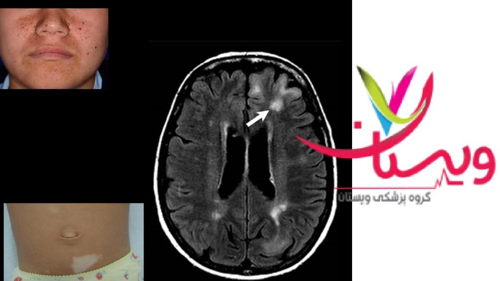 نشانه توبروز اسکلروزیس توبروز اسکلروزیس