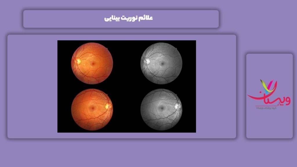 نشانه نوریت بینایی نشانههای نوریت در بینایی