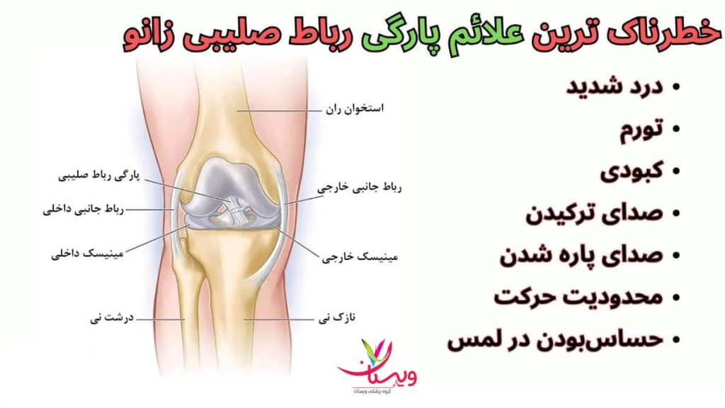 علائم پارگی رباط زانو
