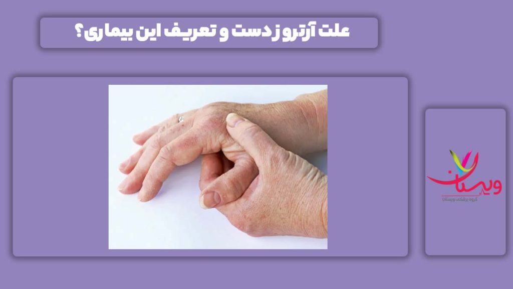 علت آرتروز برای دست آرتروز دست