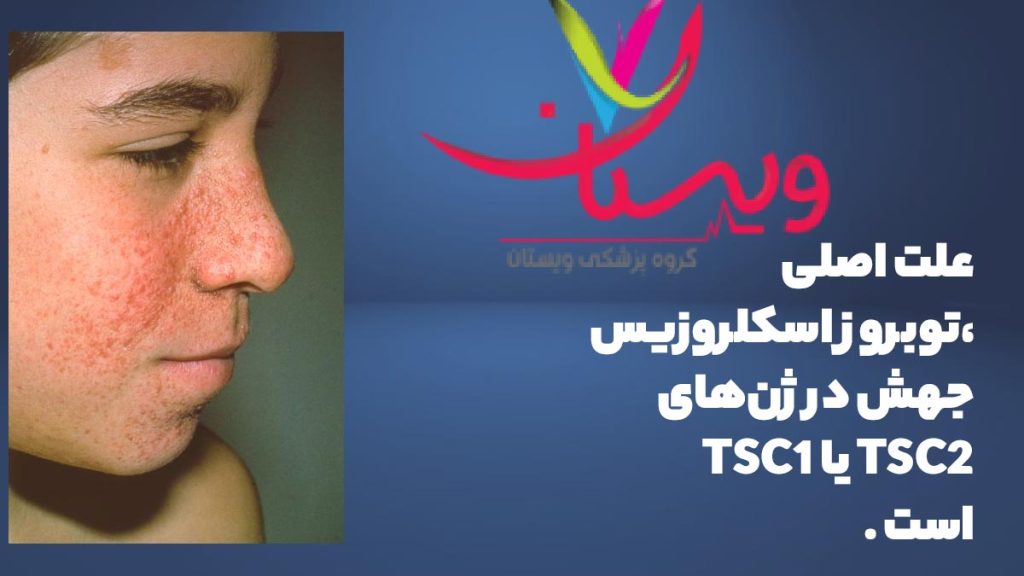 علت بیماری توبروز اسکلروزیس علت بیماری توبروز اسکلروزیس