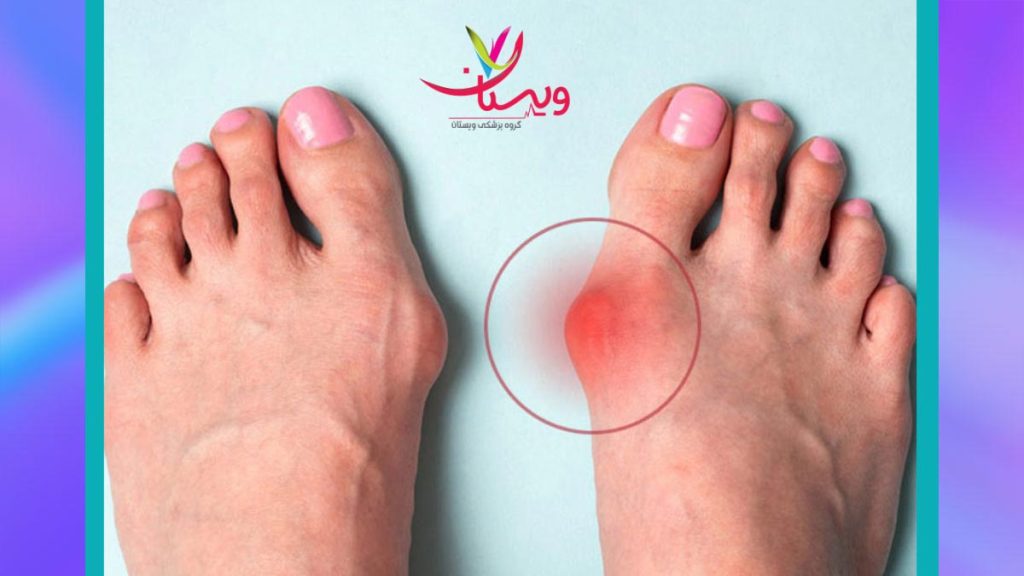 علت درد پاشنه سمت راست پا علت درد پاشنه پا سمت راست