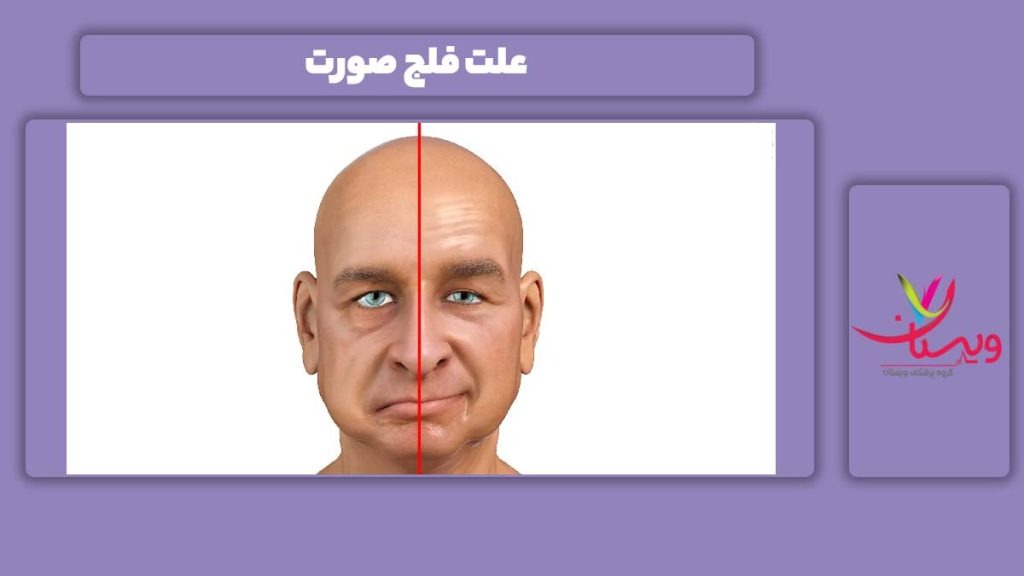 علت فلج شدن ناحیه صورت علل فلج شدن صورت