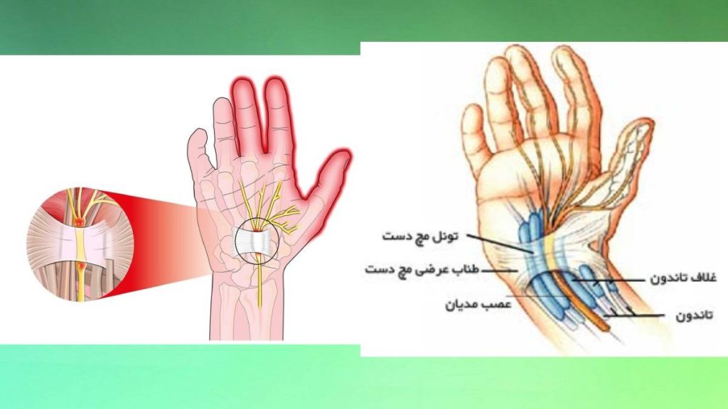 عوامل ایجاد سندروم عامل بوجود آمدن سندروم تونل کارپال