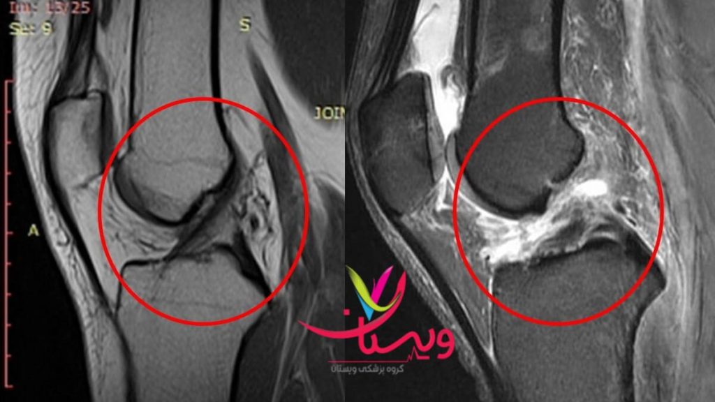 عکس ام آر آی از رباط زانو عکس ام آر آی برای جلوگیری از پارگی رباط زانو