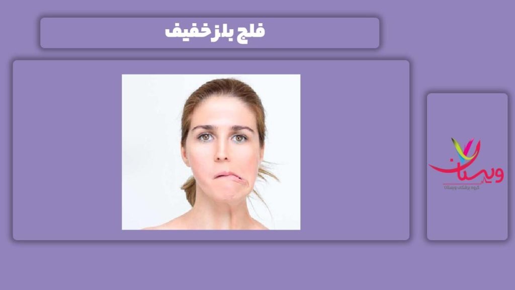 فلج بلز جزئی فلج بلز خفیف