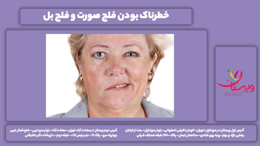 فلج صورت
