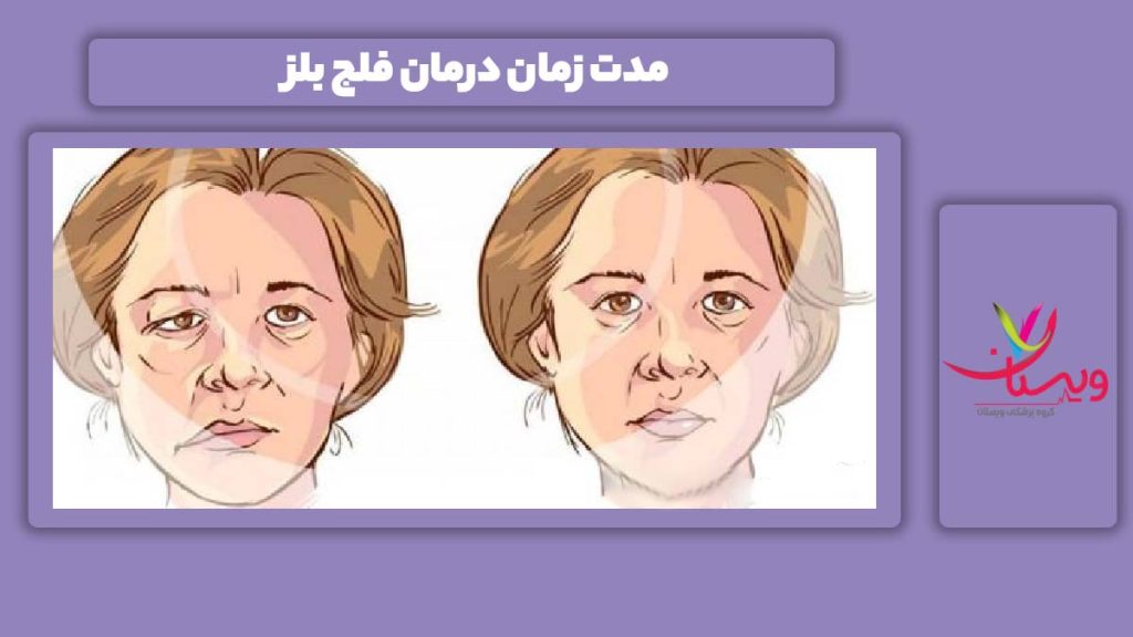 طول درمان فلج بلز زمان درمان فلج بلز