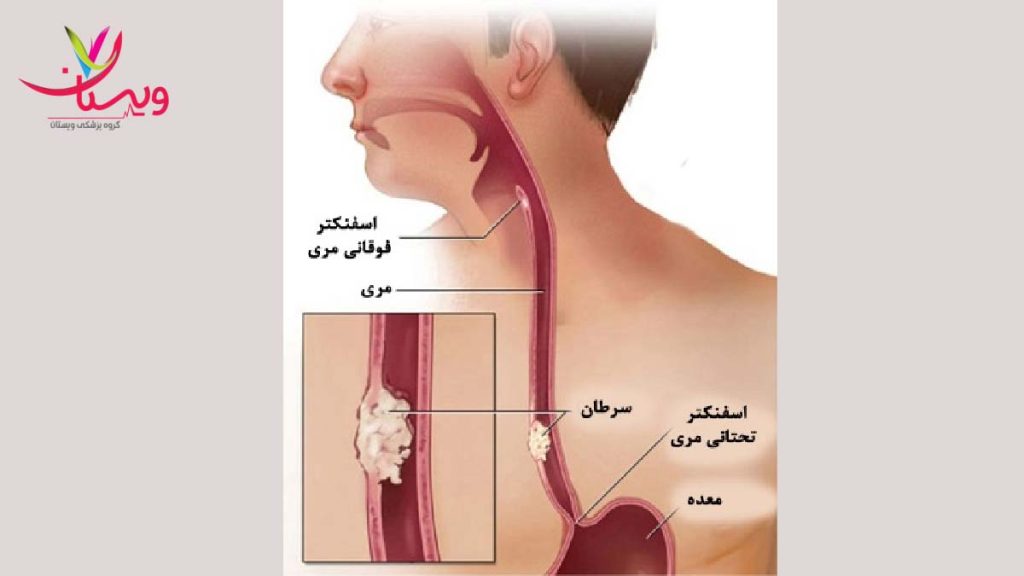 مشکل مری و بلع غذا بلع غذا در مری