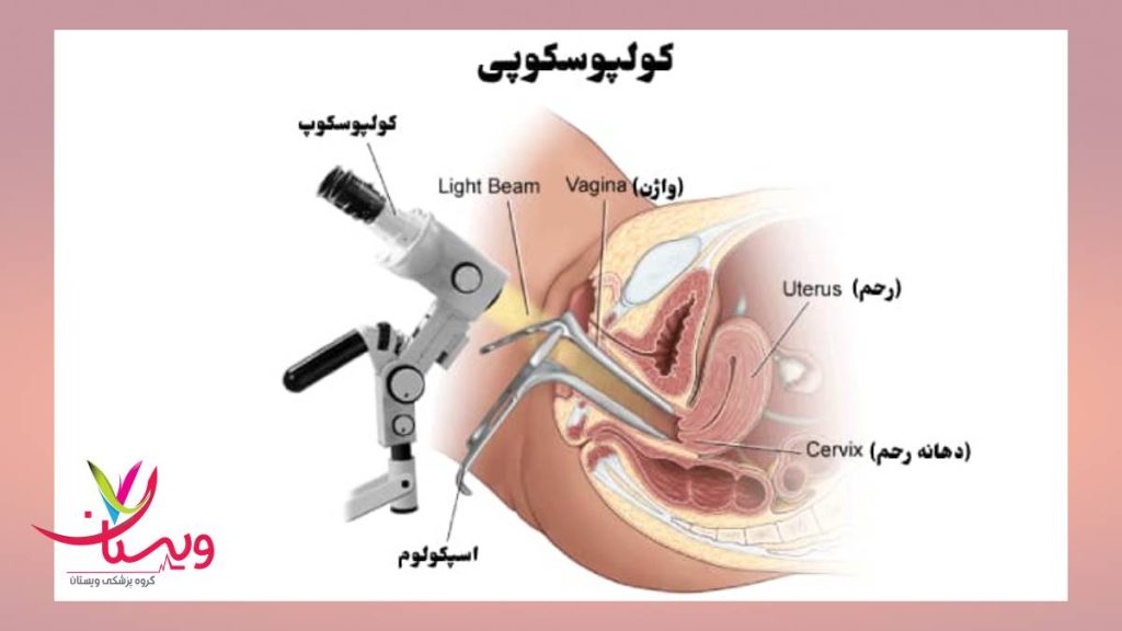 روش انجام کولپوسکوپی تعریف کولپوسکوپی