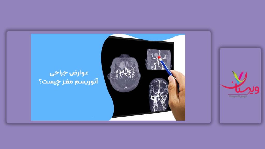 عوارض بعد از جراحی آنوریسم مغز آنوریسم مغز